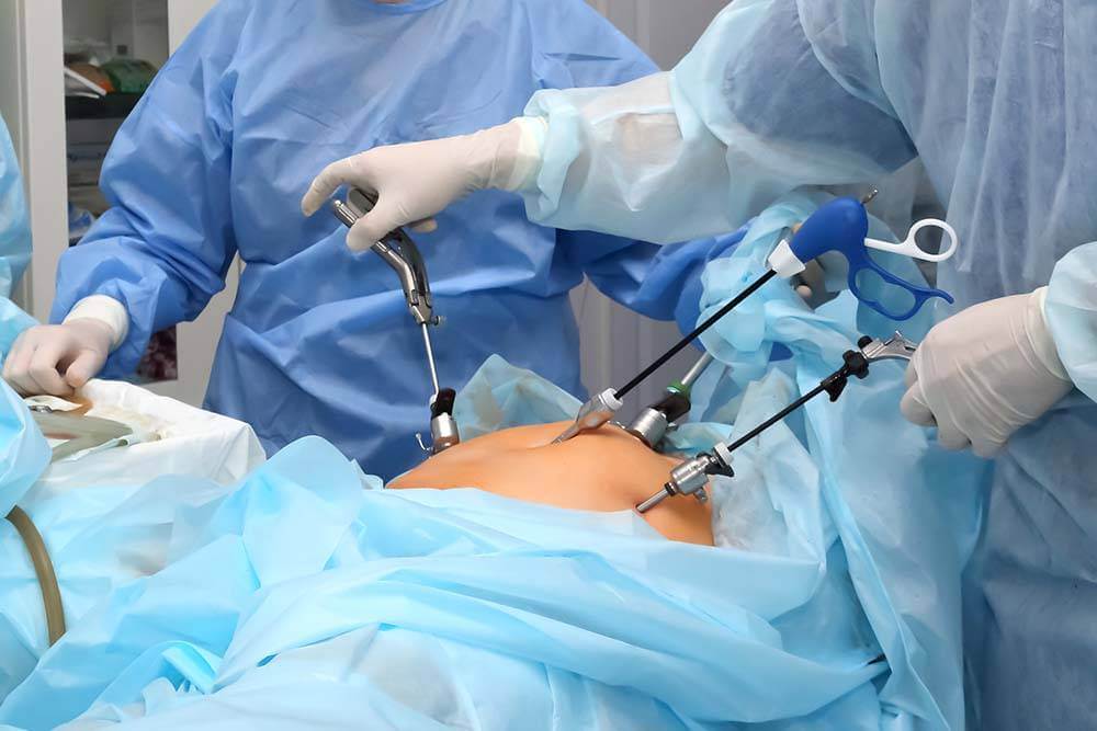 Laparoscopic Surgery